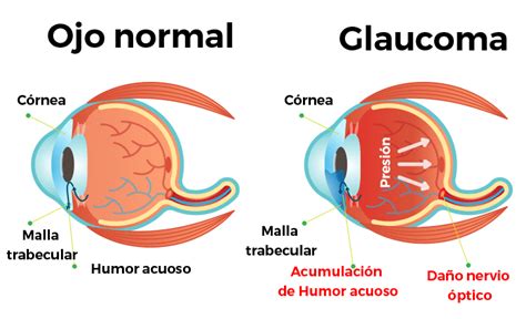 que es glaucoma en los ojos - para que serve o kóide d